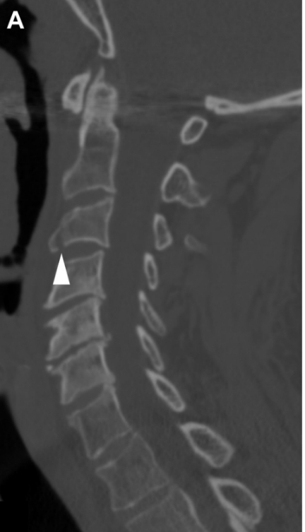 Lagrima  por  hiperextensión (estable)
-Nivel C2-C3.
- Avulsion ligamento longitudinal anterior.