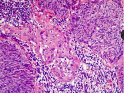 Carcinoma squamoso (a cellule fusate)