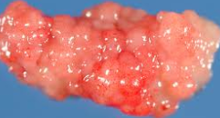 Embryonal Rhabdomyosarcoma