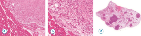 Capacidad para invadir y metastatizar: para crear nuevos focos cancerosos.