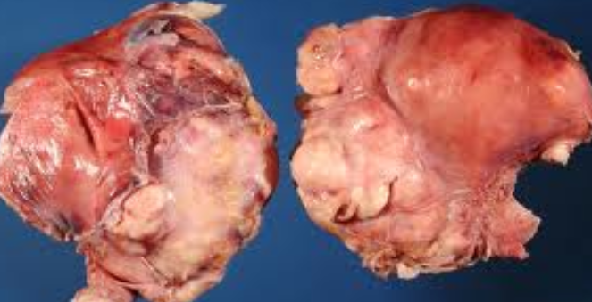 Leiomyosarcoma