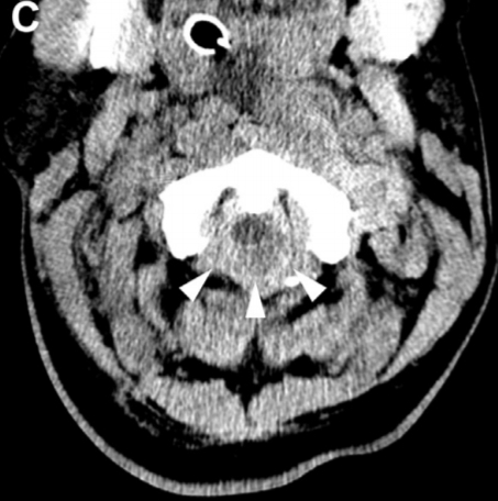 Foramen  magno
- Hemorragia subaracnoidea.