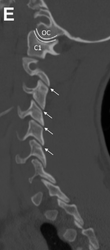 PARASAGITAL 
Int. atlantoccipital: 
⬇️ 1.4 mm
Facetas: ⬇️2mm