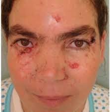 - I pazienti presentano una facies caratteristica con: