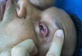Traumatismo de ojo