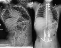 - MODIFICAZIONE ORGANI ENDOCAVITARI: ipertrofia cuore destro, stasi nel piccolo circolo... (si instaurano nei casi gravi).