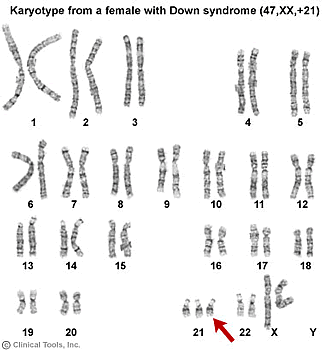 This karyotype is showing the karyotype of a female who has down syndrome. If you do not know the name of the abnormality, yo