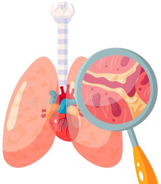 Bronquitis