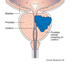 Localised Prostate Cancer