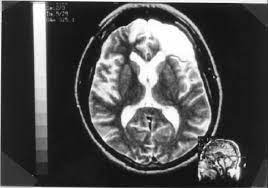 Lesión Prefrontal