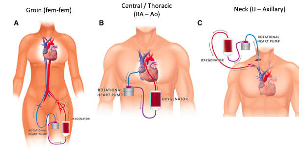 VA ECMO Cannulation