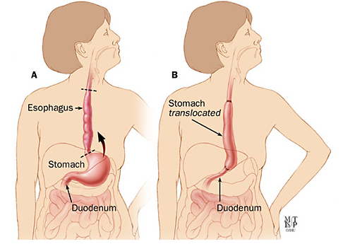 Esophagectomy