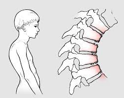 - O. VERTEBRALE GIOVANILE (M. di Scheuermann) (x2):