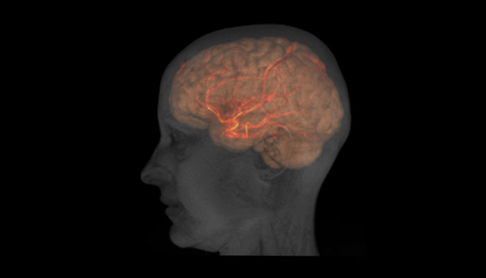 También se estudia la idea de que la reducción del flujo sanguíneo dentro del cerebro es un contribuyente clave. al alzhéimer