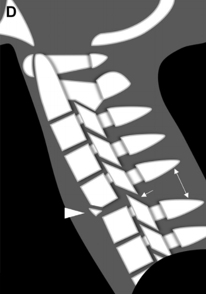 Fractura en lagrima por flexión (inestable)
- hiperflexion  ➕ carga axiial
- sindrome medular anterior
