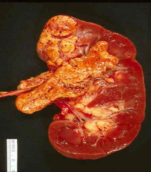 carcinoma que invade el hilio