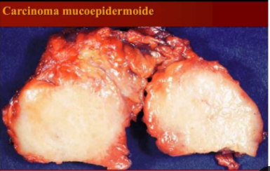Carcinoma mucoepidermoide