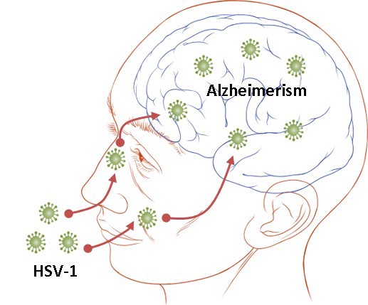 HIPÓTESIS INFECCIOSA Y NEUROINFLAMATORIA                                   ------------------------------------    
Ruth Itzh