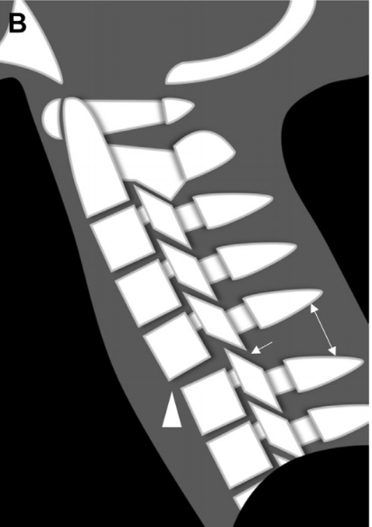 Subluxación anterior (inestable)
- ruptura ligamento longitudinal posterior
- ⬆️ morbilidad ➡️ Luxación tardia
- ⬇️ Deficit n
