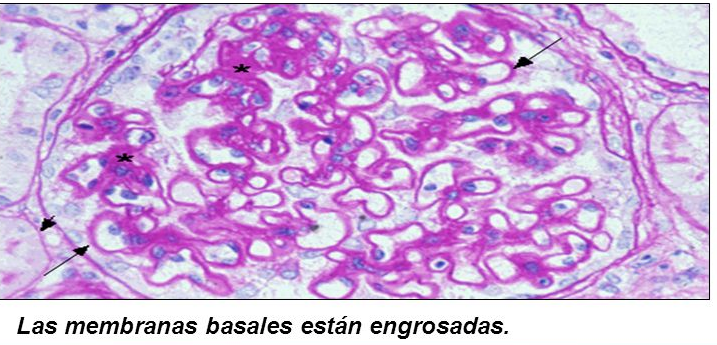 ENGROSAMIENTO DE LA MEMBRANA BASAL DE LOS CAPILARES