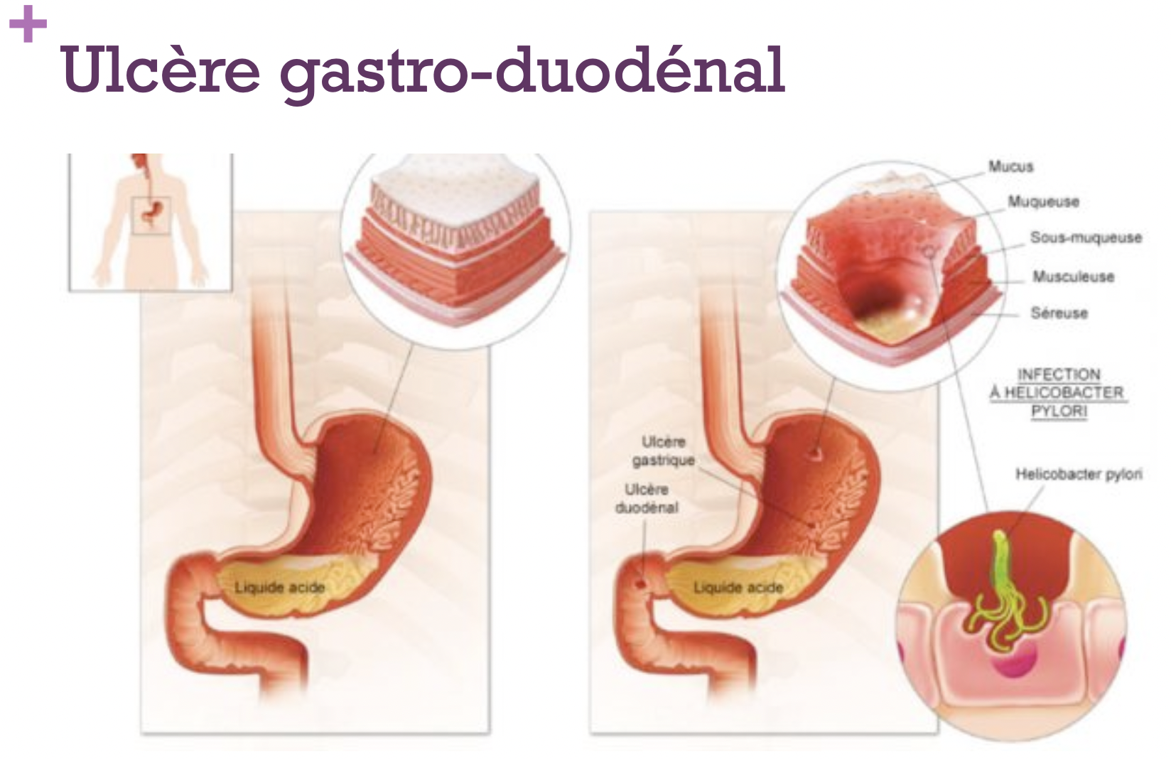 Ulcères gastriques:
Classiquement l’ulcère gastrique donne des douleurs de type crampe, au niveau épigastriques, 2-4 heures a