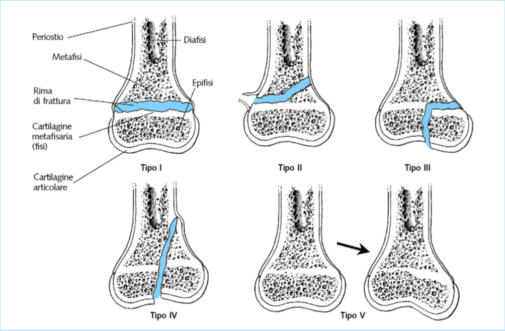 Secondo i criteri radiografici di Salter e Harris possiamo avere distacchi di vario tipo:
