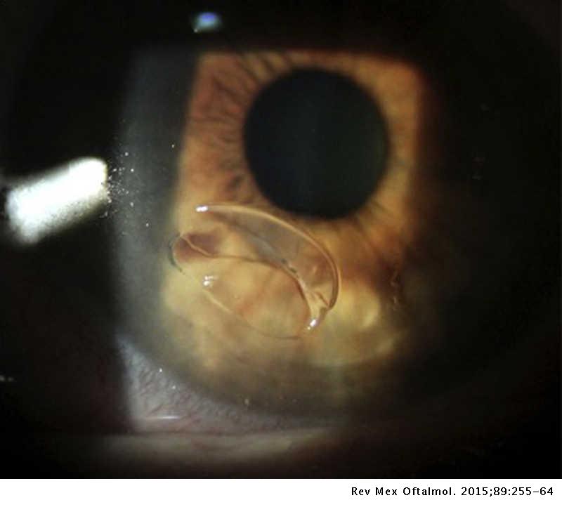 Erosión Corneal
