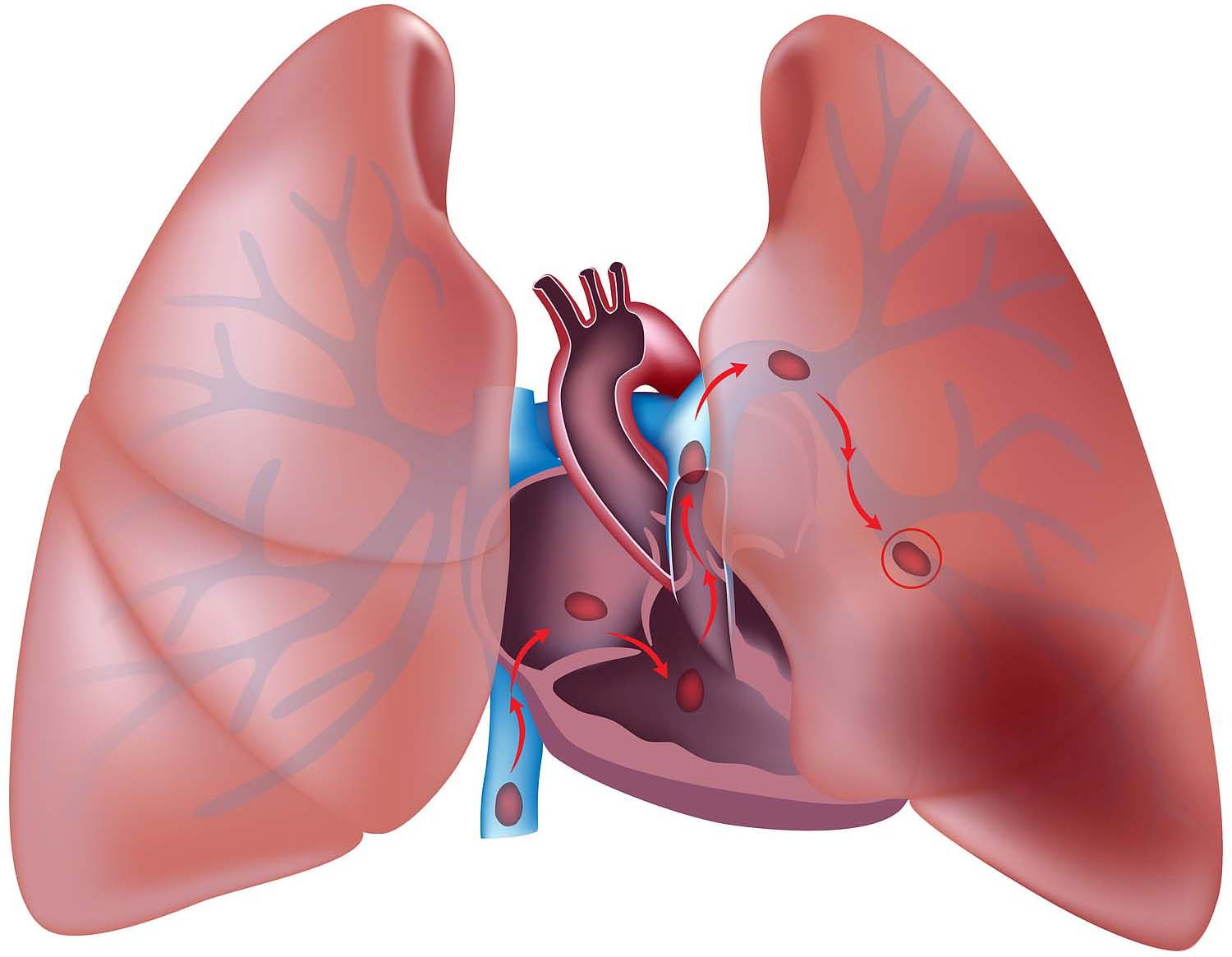Embolism