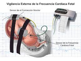 Monitoreo electrónico fetal