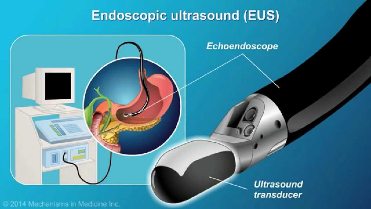 Endoscopic ultrasound (EUS)