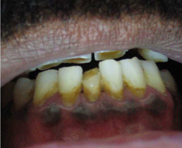 LESIONES PIGMENTADAS