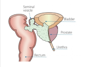 Metastatic Prostate Cancer (mPC)