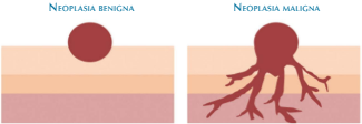 Neoplasia: crecimiento anormal, excesivo y descoordinado de un tejido comparado con uno normal.