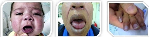 CIANOSIS