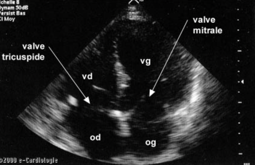 Echographie cardiaque