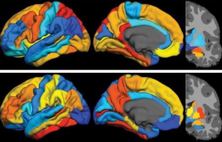 Sobrediagnóstico en base hacer diagnóstico precoz y favorecer el miedo al Alzheimer. Desde ahí, par paso a un posible sobretr