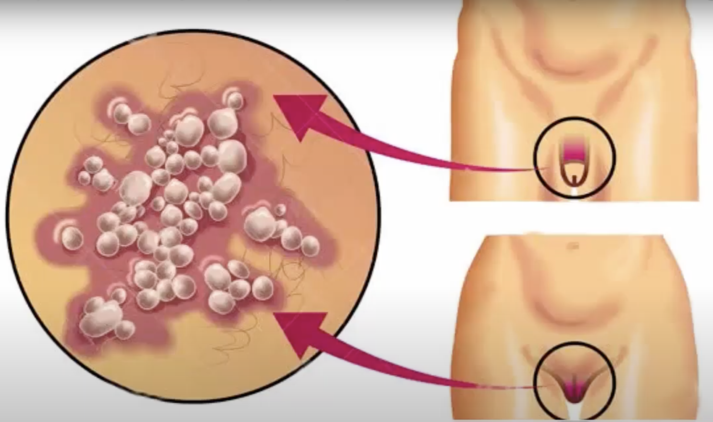 Genital ulcerations commonly on scrotum and vulva