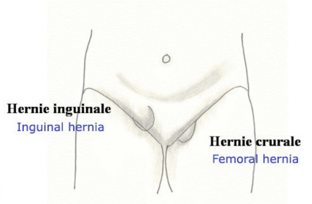 Hernies crurales et inguinales:
Elle survient généralement brutalement après l’effort.
Il apparaît une tuméfaction à la parti