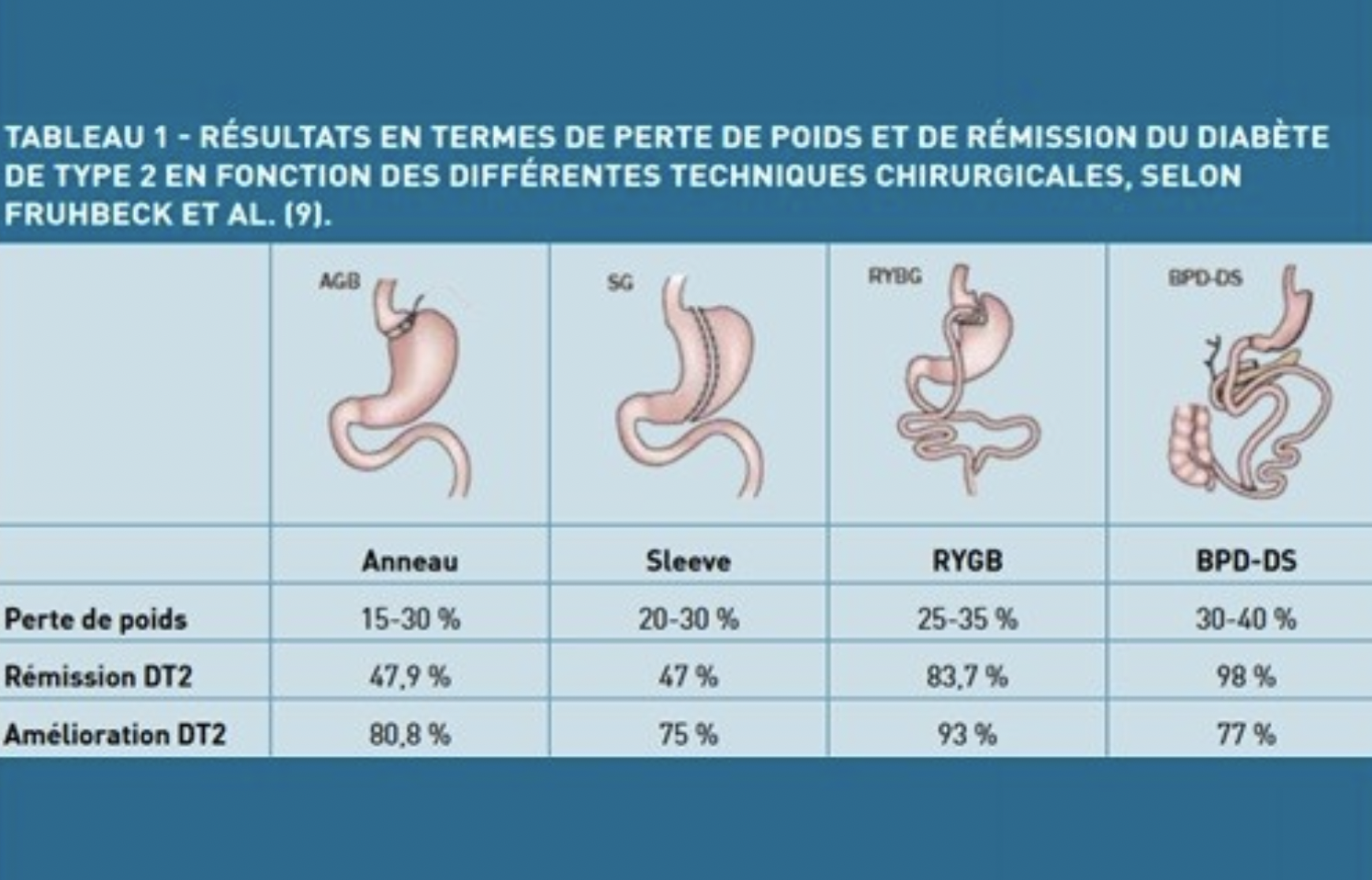 Chirurgie bariatique:
Le bypass
La chirurgie bariatrique est en plein essor depuis quelques années. Elle a remplacé les annea