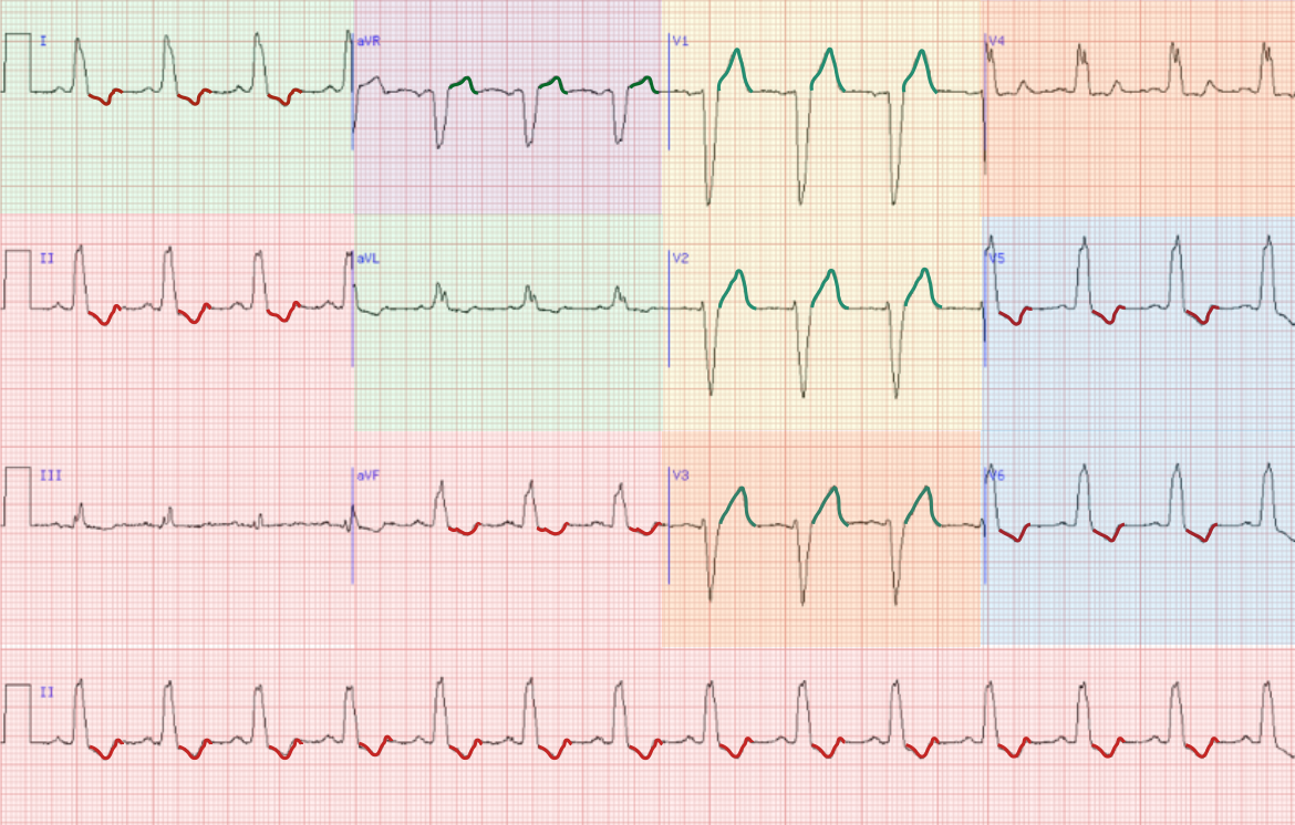 Electrocardiograma realizado en los primeros 10 minutos
