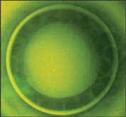 Apical Clearance