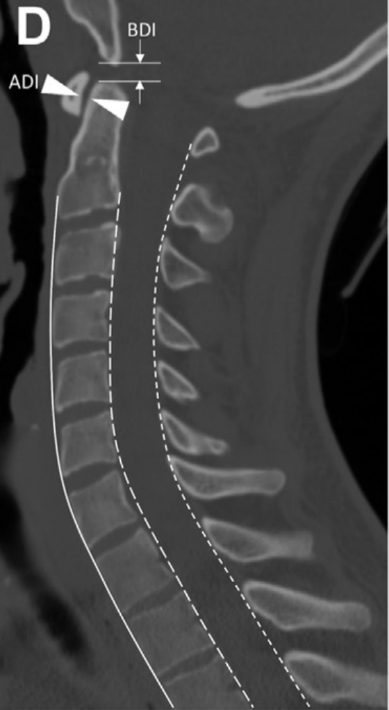 Plano Sagital 
Grasa prevertebral
Lineas espinales
Int: basion- odontoideo: ⬇️9.5 MM 
Int. Atlanto odontoideo : ⬇️ 3 mm