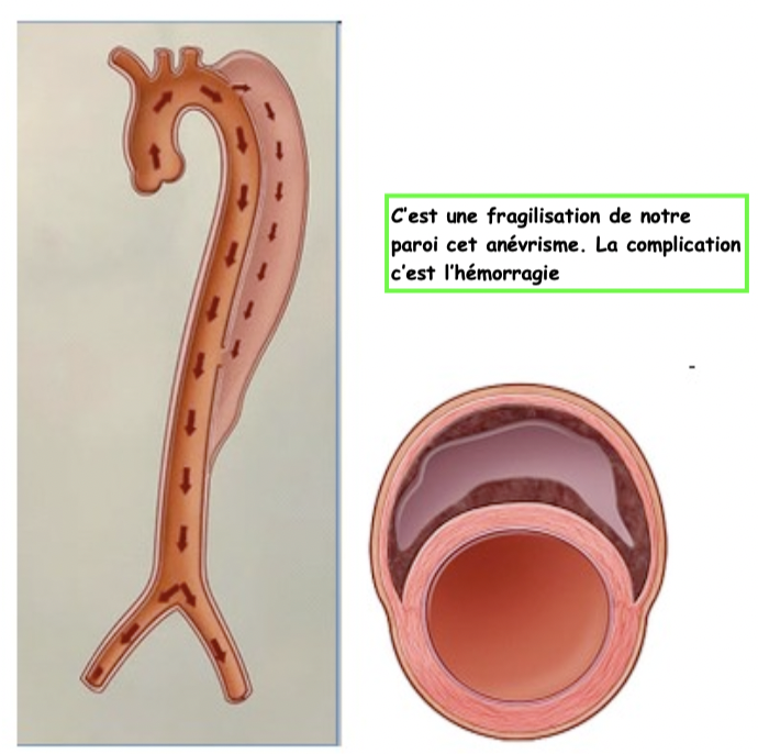 Etiologie & anévrisme:
La cause la plus fréquente des dissections aortiques est la présence au préalable d’un anévrisme de la