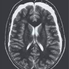 RMN cerebro