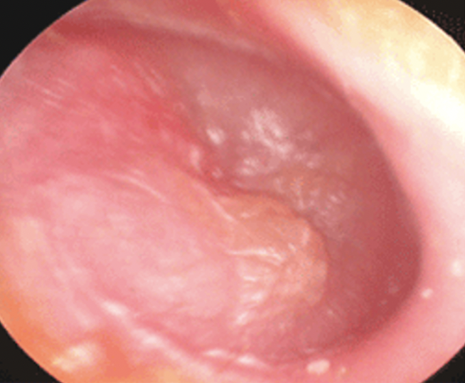 Tympan sain vu à l'otoscope