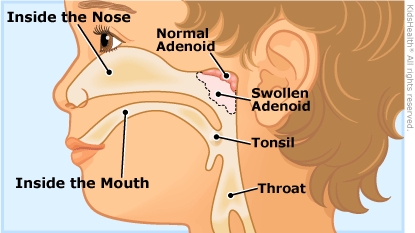 Adenoids & Adenoidectomies