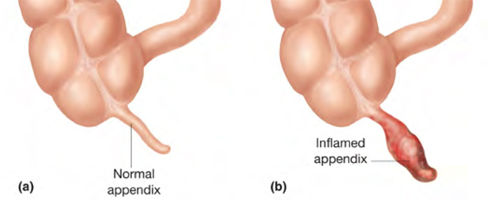 Appendicitis (Pain/infection in the abdomen)