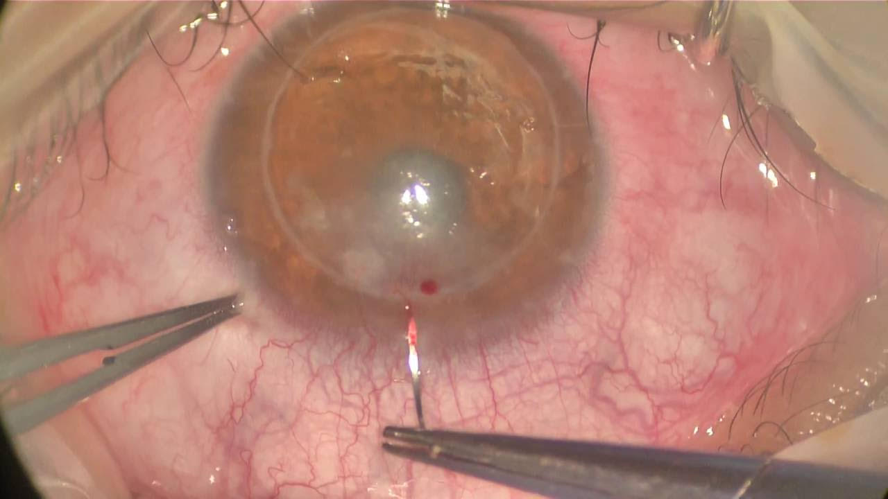 Neovascularización Corneal