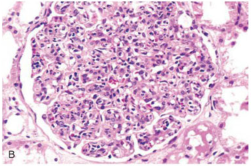 glomerulos hipercelulares aumentados de tamaño