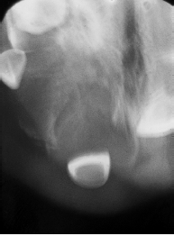 Tumor neuroectodérmico pigmentado de la infancia